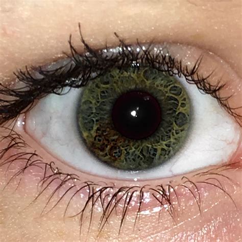 how rare is sectoral heterochromia.
